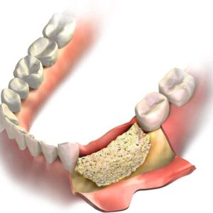 Bone & Membrane